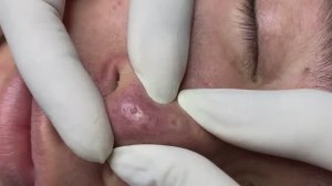 Relax Acne 006 • АСМР • Loan Nguyen collection