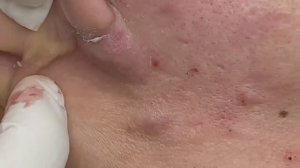 Лечение воспаления гематомы, абсцесса в области уха и челюсти у клиентов. #лечениеабсцесса #гематома