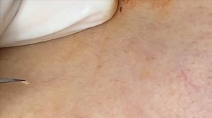 Прыщи (акне), скрывающиеся под кожей из-за регулярного макияжа.  #прыщи #угри #угреваясыпь