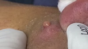 Чистка кожи с угрями. Осторожная работа. 2140  #прыщи #угри #угреваясыпь #удалениепрыщей