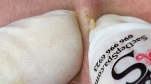 Чистка кожи от прыщей, камедонов и черных точек #1