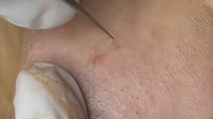 Прыщи (акне), скрывающиеся под кожей из-за регулярного макияжа.  #прыщи #угри #угреваясыпь