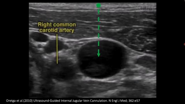 Установка катетеров в вену под контролем УЗИ рама лекция для врачей УЗИ