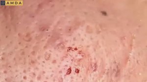 Чистка лица: профессиональная экстракция 2072.  #комедоны #проблемнаякожа #уходзалицом