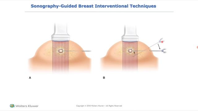 УЗИ грудных желез рама лекция для врачей