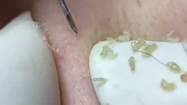 Relax Acne 028 • АСМР • Loan Nguyen collection смотреть онлайн