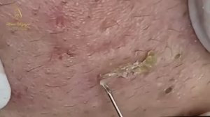 ASMR для сна: шепот и тихие звуки чистки. 2148 #черныеточки #чисткалица  #прыщи #угри