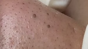 Удаление черных точек, которые никогда не давали покоя. 2158  #прыщи #угри #удалениепрыщей