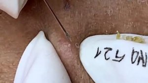 Relax Acne 030 • АСМР • Loan Nguyen collection