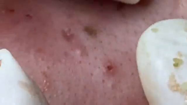 Relax Acne 029 • АСМР • Loan Nguyen collection смотреть онлайн