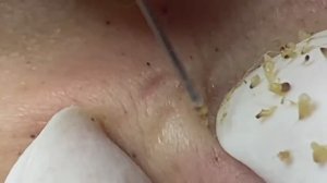 Relax Acne 007 • АСМР • Loan Nguyen collection