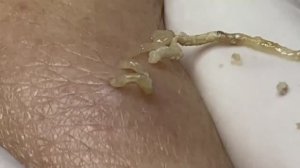 Чистка кожи от комедонов II и III степени. 2152  #комедоны #проблемнаякожа #уходзалицом