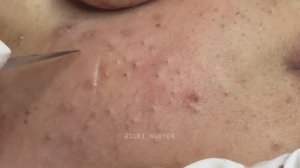 Потрясающее удаление воспаленных черных точек. Часть 2 Серия Suri_1