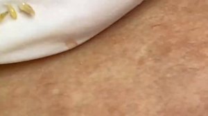 Чистка кожи от прыщей, камедонов и черных точек #4