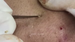 Потрясающее удаление воспаленных черных точек. Часть 1 Серия Suri_1