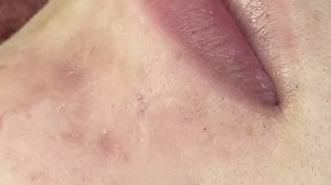 Глубокие подкожные черные точки (комедоны)  #комедоны #проблемнаякожа #уходзалицом