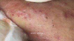 Потрясающее удаление воспаленных черных точек. Часть 3 Серия Suri_1