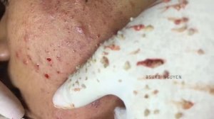 Потрясающее удаление прыщей Часть 2 #выдавливаниепрыщей #прыщи #акне Suri Job 01