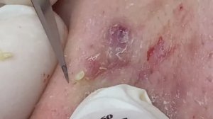 Чистка кожи от прыщей, камедонов и черных точек #3