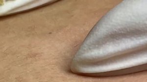 Чистка кожи от прыщей, камедонов и черных точек #5