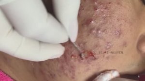 Потрясающее удаление прыщей Часть 1 #выдавливаниепрыщей #прыщи #акне Suri Job 01