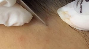 Лечение черных точек у молодой девушки #черныеточки