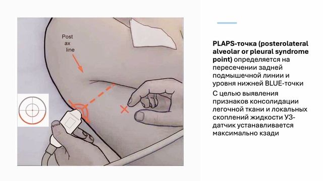 ОСНОВЫ УЗИ ЛЕГКИХ И BLUE-protocol blueprotocol fast rush ultrasound emergency icu узи