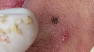 Чистка кожи от прыщей, камедонов и черных точек #10