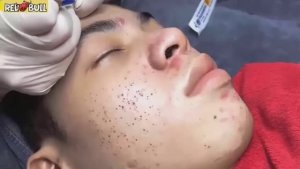 Профессиональное очищение от белых угрей. Расслаблющее видео. 𝟗𝟎𝟎𝟐