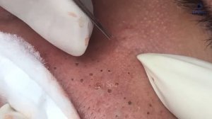 Полное видео выдавливания черных точек — Часть 2