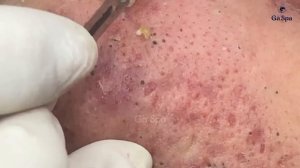 Полное видео выдавливания черных точек — Часть 1