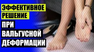 😷 Вальгусная деформация большого пальца ноги 💡 Воспаление шишек на ногах что делать 👍