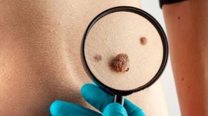 Российские врачи победили злокачественную меланому и создали индивидуальную вакцину