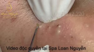 Удаление черных точек и огромных подкожных комедонов 6-летней давности