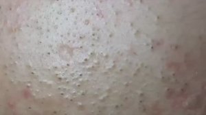 Множественные черные точки на лбу - Удаление комедонов