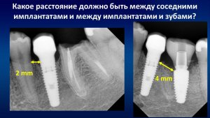 Какое расстояние должно быть между соседними имплантатами и между имплантатами и зубами?  Часть 3.