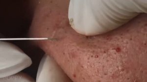 Самое удовлетворяющее удаление комедонов и акне