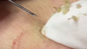 Выдавливание прыщей, угрей, черных точек и камедонов #13