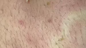 Удаление черных точек на спине #черныеточки #чисткаспины