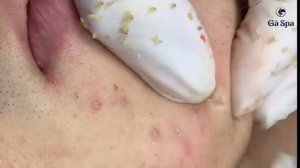 Очень круто!!! Новое видео удаления черных точек #черныеточки #чисткалица