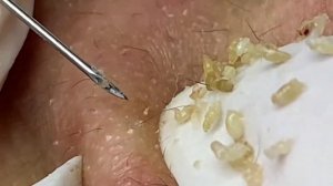 Выдавливание прыщей, угрей, черных точек и камедонов #16