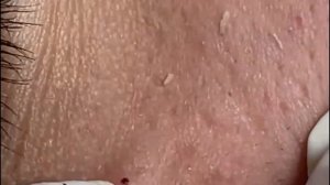 Выдавливание прыщей, угрей, черных точек и камедонов #15