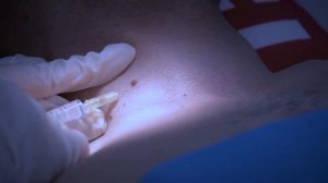 Удаление папиломы