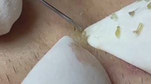 Relax Acne 012 • АСМР • Loan Nguyen collection