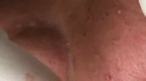 Глубокие черные точки: извлекаем с щек и носа #чисткалица