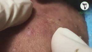 Профессиональное лечение черных точек. #черныеточки #лечениеакне #чисткалица