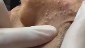 Черные точки на носу и лбу. Смотрите и расслабляйтесь!