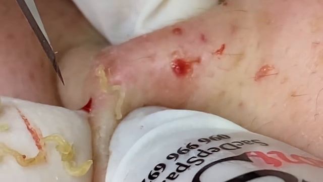 Выдавливание прыщей, угрей, черных точек и камедонов #18