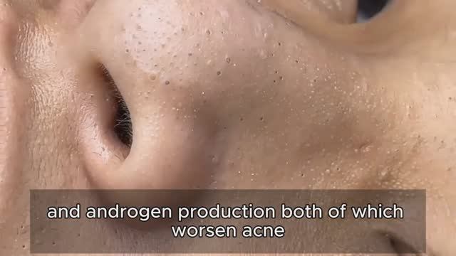 Механическое очищение кожи от комедонов: техника. 90389