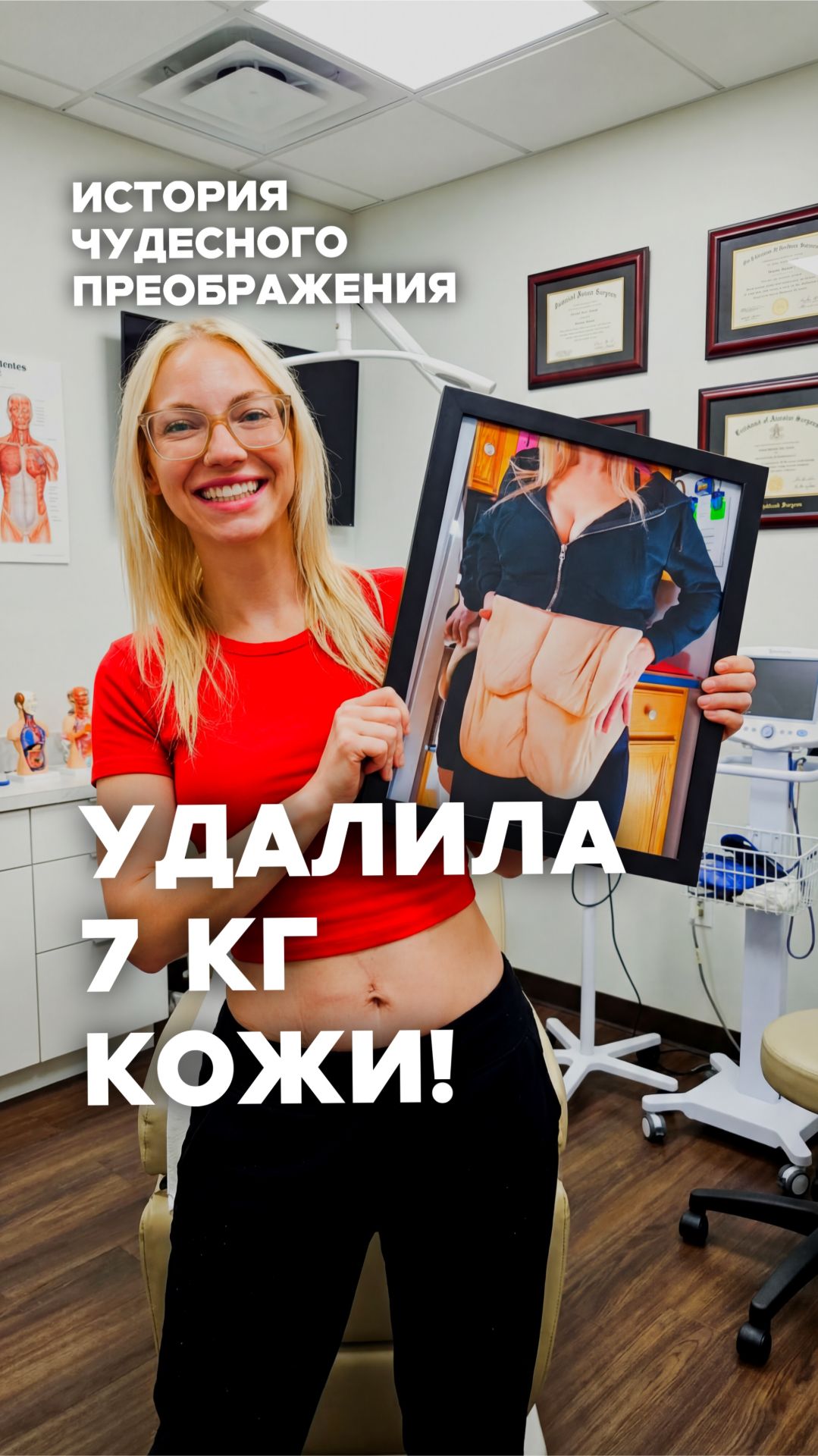 История похудения: -70 кг и абдоминопластика